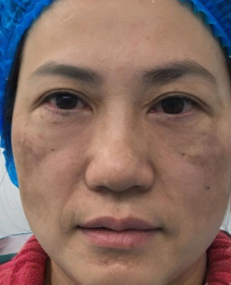 去眼袋手术