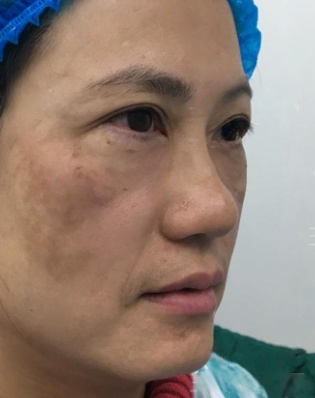 去眼袋手术