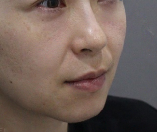 去眼袋手术