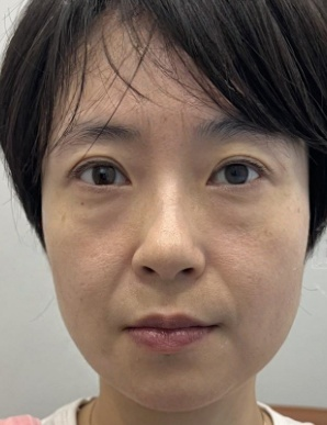 去眼袋手术