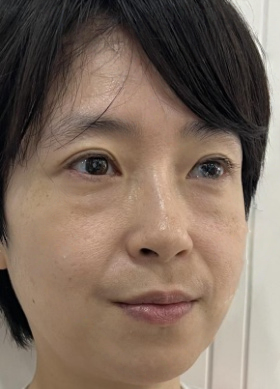 去眼袋手术