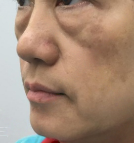 去眼袋手术