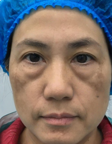 去眼袋手术