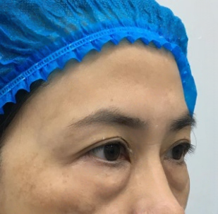 去眼袋手术