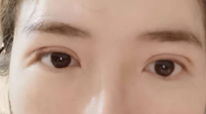 双眼皮手术