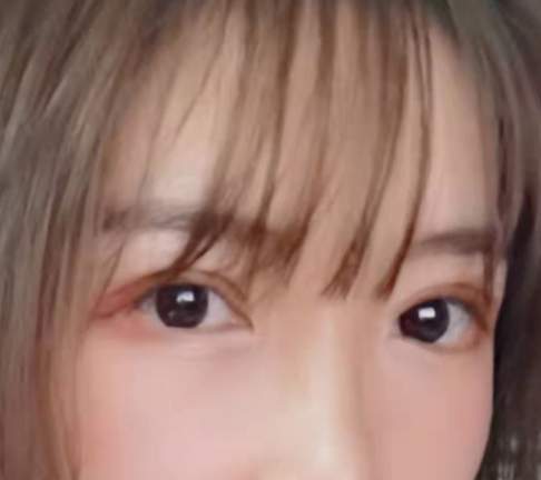 双眼皮手术