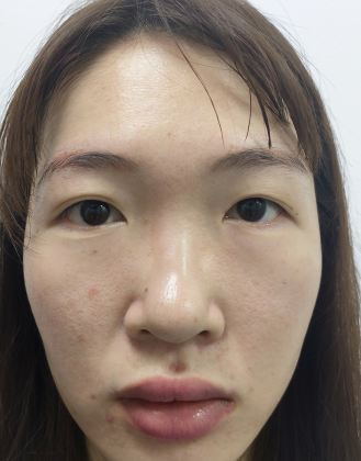 双眼皮手术