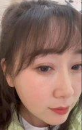 去眼袋手术