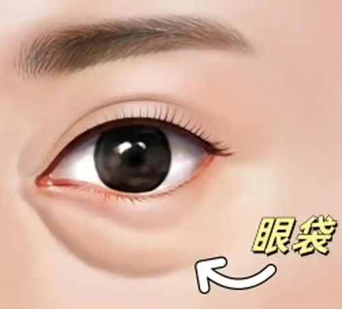 去眼袋手术