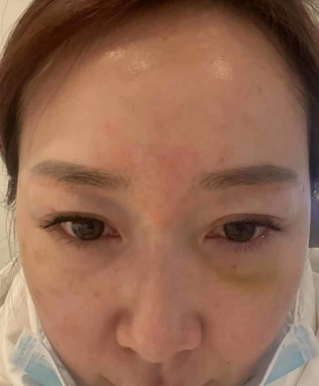 去眼袋手术