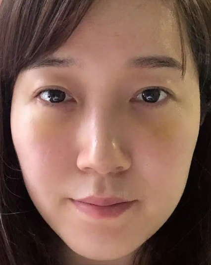 去眼袋手术