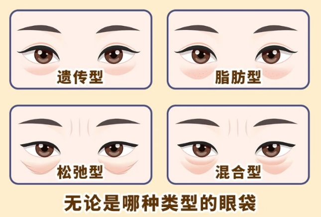 去眼袋手术