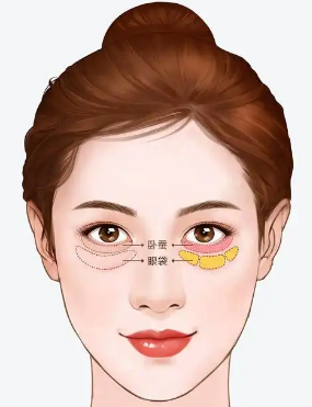 去眼袋手术