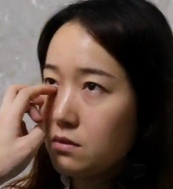 去眼袋手术