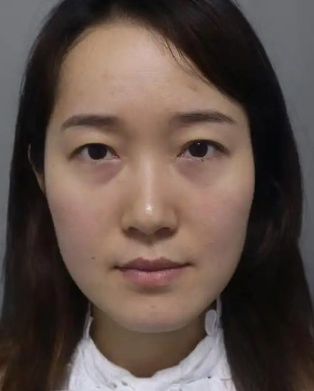 去眼袋手术