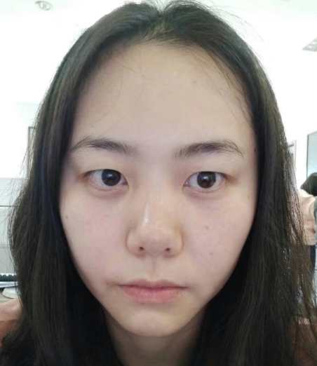 去眼袋手术