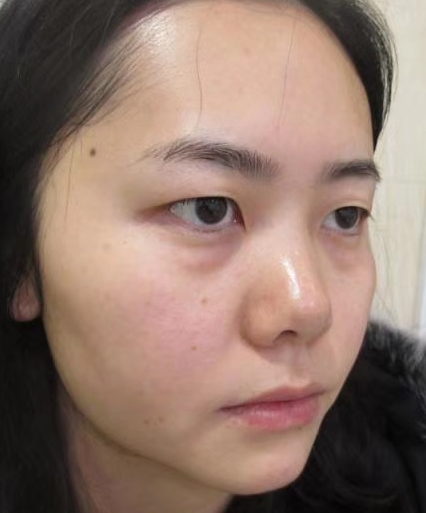 去眼袋手术