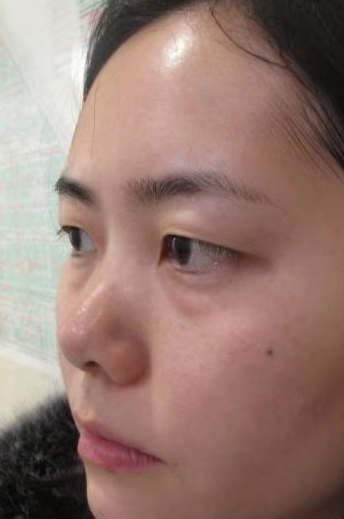 去眼袋手术
