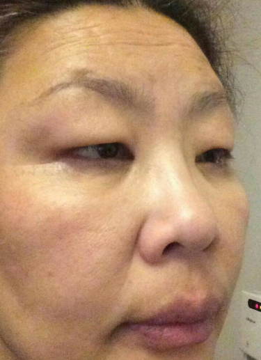 去眼袋手术