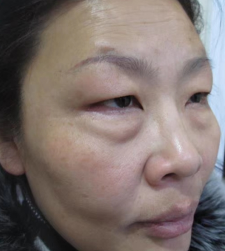 去眼袋手术