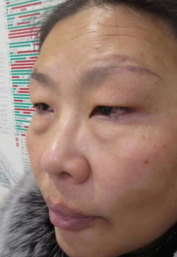 去眼袋手术