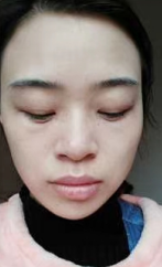眼袋