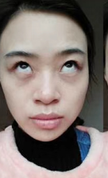 眼袋
