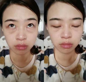 眼袋