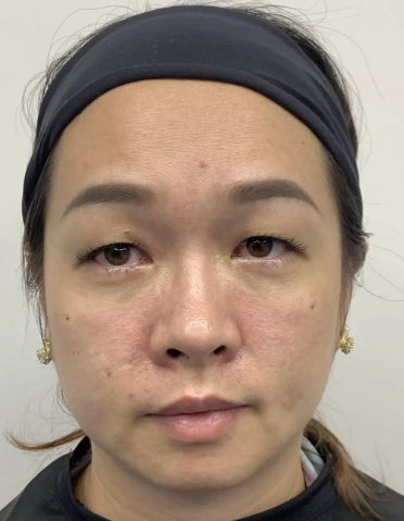去眼袋手术