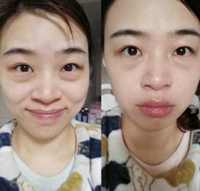 眼袋
