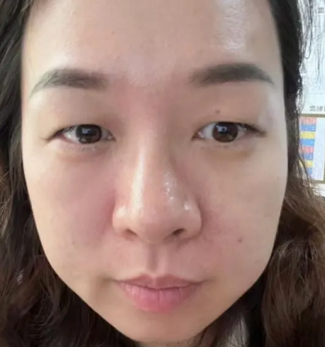 去眼袋手术