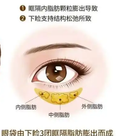去眼袋手术