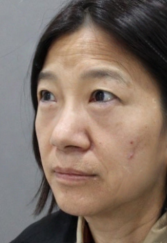 去眼袋手术