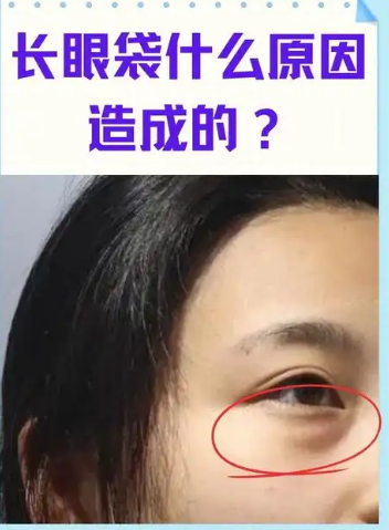 去眼袋手术