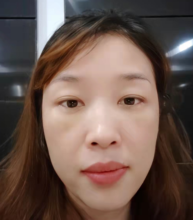 去眼袋手术