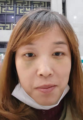 去眼袋手术