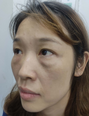 去眼袋手术