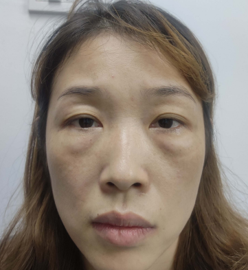 去眼袋手术