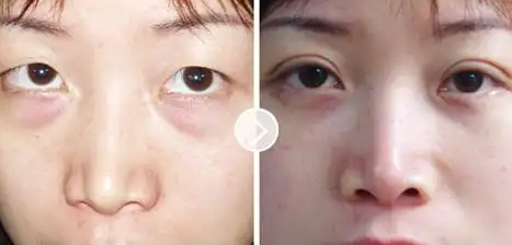 去眼袋手术