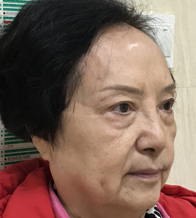 去眼袋手术