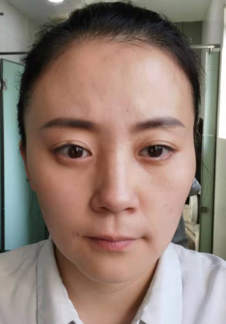 去眼袋手术