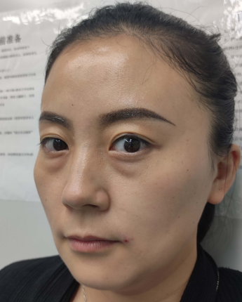 去眼袋手术