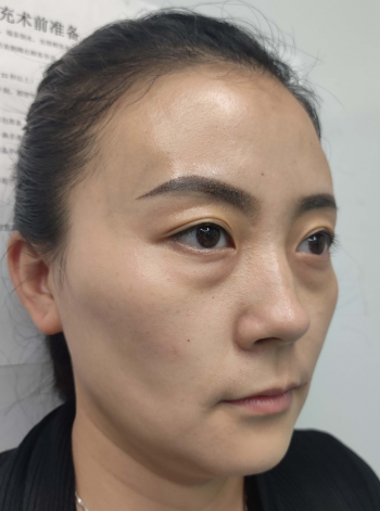 去眼袋手术