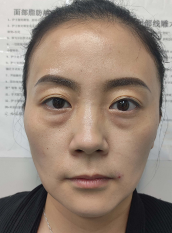 去眼袋手术