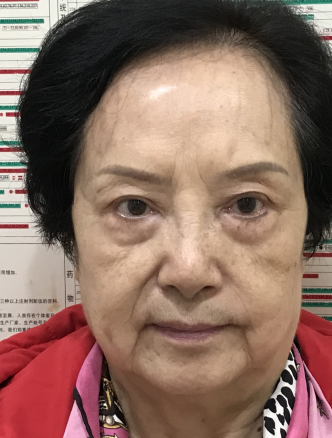 去眼袋手术