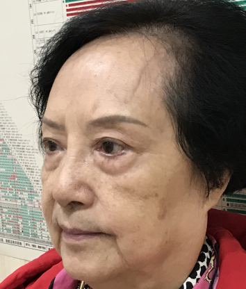 去眼袋手术