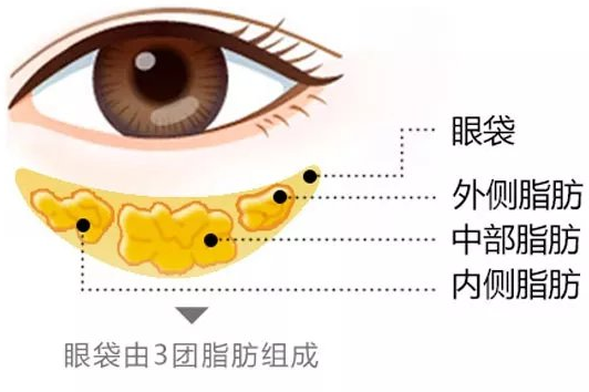 去眼袋手术