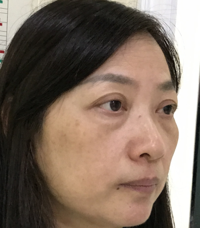 去眼袋手术