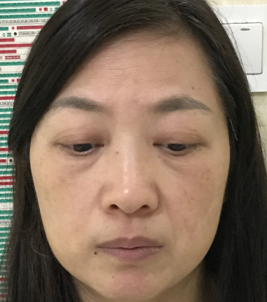 去眼袋手术