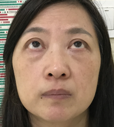 去眼袋手术